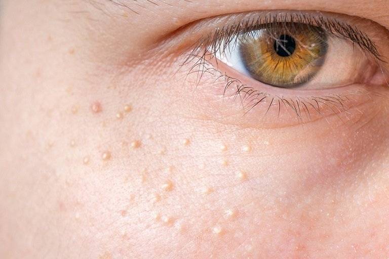 کلسینوز کوتیس یا رسوب کلسیم چه زمانی اتفاق می افتد؟